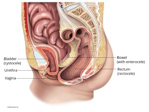 درمان افتادگی رحم