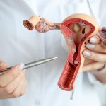 درمان کیست تخمدان