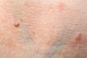 درمان زگیل تناسلی