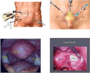 تفاوت لاپاراسکوپی با جراحی باز چیست؟